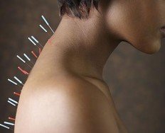 Acupuncture needles in African woman